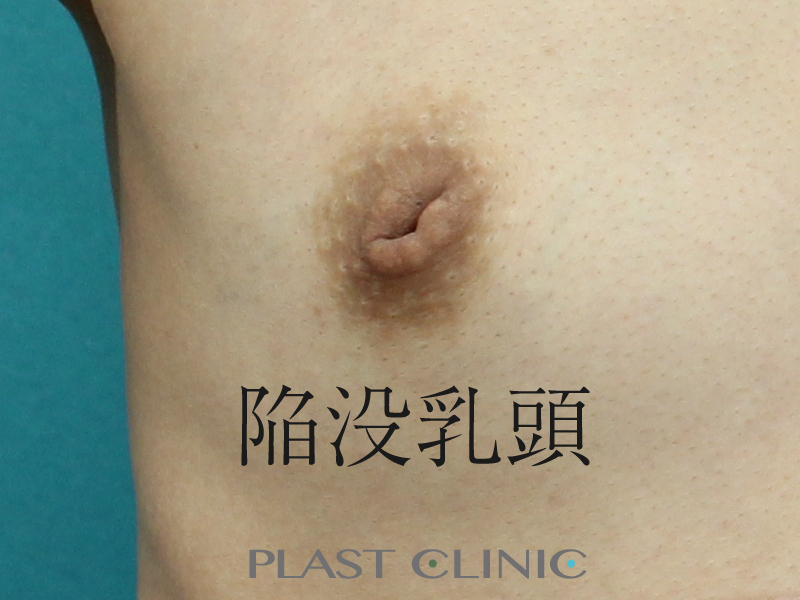 陥没乳頭