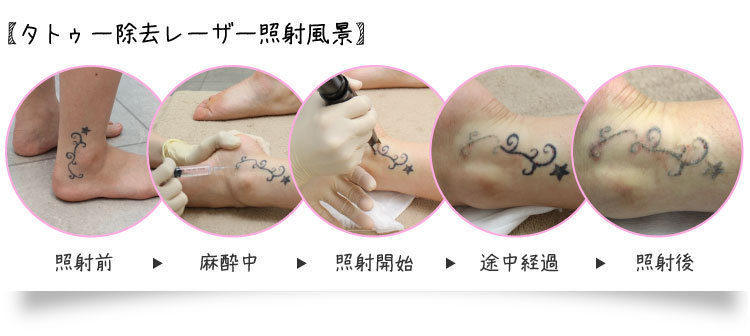 タトゥー 刺青除去 東京 日暮里 プラストクリニック 形成外科 美容皮膚科 美容外科