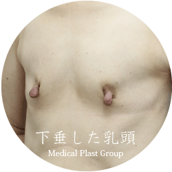 垂れたり伸びたりした乳首を治す方法 授乳 加齢 アトピー 東京 日暮里 プラストクリニック 形成外科 美容皮膚科 美容外科