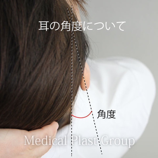 立ち耳を治す形成手術 東京 日暮里 プラストクリニック 形成外科 美容皮膚科 美容外科 立ち耳を治す形成手術 東京 日暮里 プラストクリニック 形成外科 美容皮膚科 美容外科