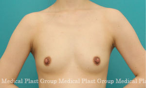 バストアップ 豊胸術 の症例 東京 日暮里 プラストクリニック 形成外科 美容皮膚科 美容外科