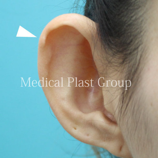 耳の尖りを治す治療 東京 日暮里 プラストクリニック 形成外科 美容皮膚科 美容外科