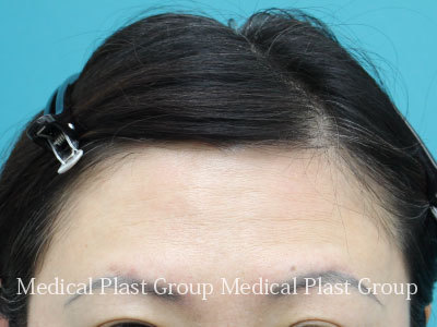 ヒアルロン酸注入で額 おでこ を丸く出す方法 東京 日暮里 プラストクリニック 形成外科 美容皮膚科 美容外科
