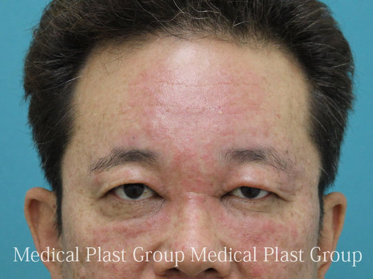 ヒアルロン酸注射の安全性と危険性 東京 日暮里 プラストクリニック 形成外科 美容皮膚科 美容外科