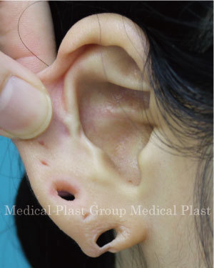 ピアス後の切れ耳 耳垂裂 耳垂裂症 東京 日暮里 プラストクリニック 形成外科 美容皮膚科 美容外科