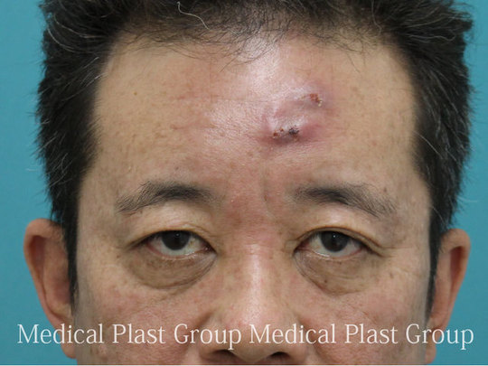 ヒアルロン酸注射の安全性と危険性 東京 日暮里 プラストクリニック 形成外科 美容皮膚科 美容外科