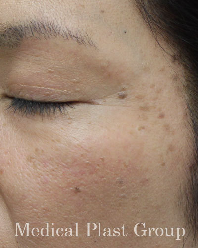 シミのもり上がり 老人性イボ 脂漏性角化症 東京 日暮里 プラストクリニック 形成外科 美容皮膚科 美容外科