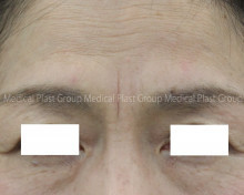 眉間のシワの原因と予防および治療について 東京 日暮里 プラストクリニック 形成外科 美容皮膚科 美容外科