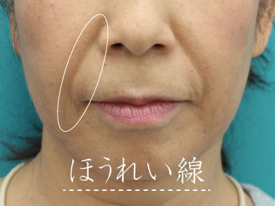 ほうれい線 鼻の横のシワ 影 東京 日暮里 プラストクリニック 形成外科 美容皮膚科 美容外科
