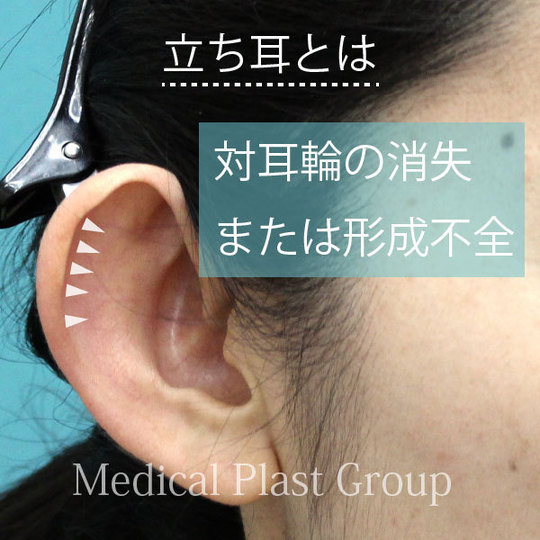 立ち耳を治す形成手術 東京 日暮里 プラストクリニック 形成外科 美容皮膚科 美容外科